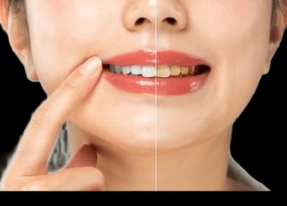 Stain Erase Teeth Whitening Pen